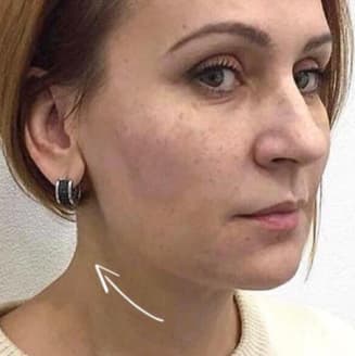 After procedure
